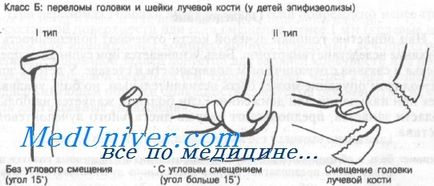 Переломи головки і шийки променевої кістки