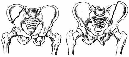 Переломи кісток таза симптоми і лікування, травматологія