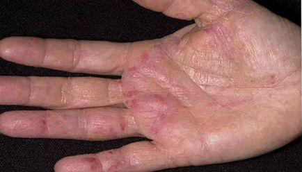 Защо получавам гъбична инфекция на кожата на ръцете, популярна медицина