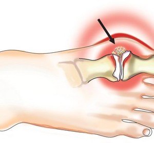 Подагру можна вилікувати в домашніх умовах дієта