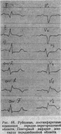 Kézi EKG (tankönyv) - dekódolása EKG