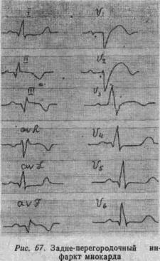 Kézi EKG (tankönyv) - dekódolása EKG