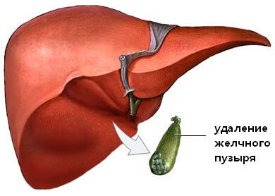 Постхолецистектомічний синдром класифікація, лікування і дієта