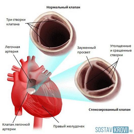 Стеноз легеневої артерії у новонароджених, дітей, дорослих, прогноз, причини і лікування