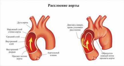 Аневризма аорти симптоми, діагностика та лікування