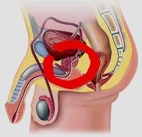 Як можна швидко вилікувати простатити у чоловіків