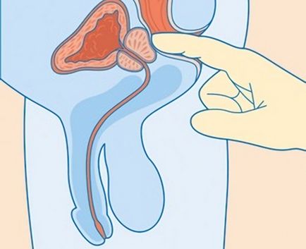 Як визначити простатит різної форми і почати лікування