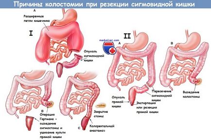 Методика резекції сигмовидної кишки