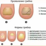 Мишача лихоманка - симптоми у дітей і дорослих, лікування і перебіг хвороби, корисні поради на