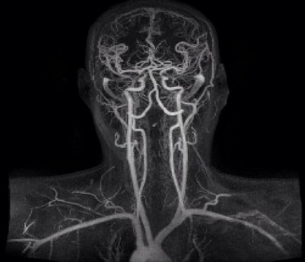 MRI angiográfia agyi artériák