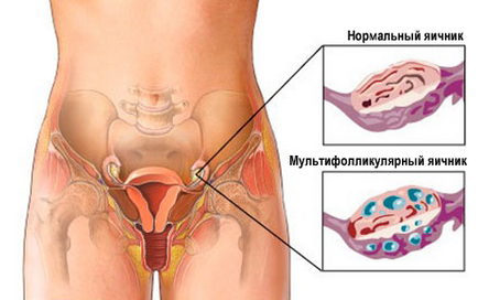 Мультіфоллікулярние яєчники