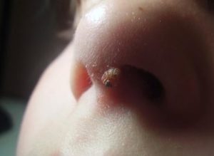 Papilom în nas cu remedii populare, Cum să eliminați papilomul în nas