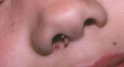 Papilom în nas cum să eliminați. Cum să recunoașteți și să tratați papilomul în nas - La femei
