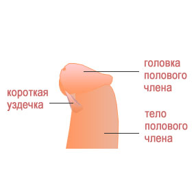 Пластика вуздечки, суть операції