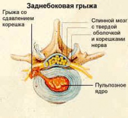 Ознаки та симптоми міжхребцевої грижі - діагностика, показання до операції