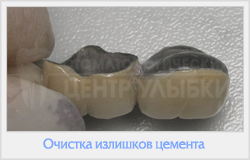 Протезування на скляних опорах (кінцевий дефект клас) Протезування на скляних опорах