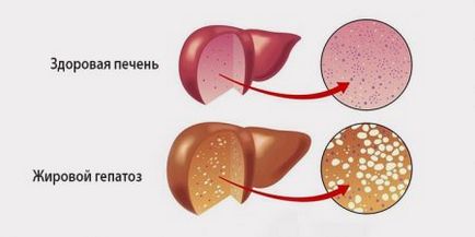 Стеатогепатоз печінки що це таке, симптоми, дієта і лікування