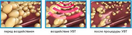 Ударно-хвильова терапія показання і протипоказання, суть методу, центри