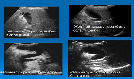 Ущільненнястінок жовчного міхура що це таке, причини - секрети здоров'я (стінок) Ущільненнястінок жовчного міхура що це таке, причини - секрети здоров'я