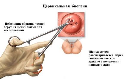 Виділення при ерозії шийки матки та інші симптоми