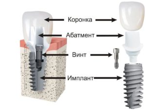 Види зубних протезів