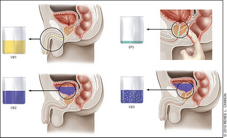 Prosztatagyulladás anális után - Prostatitis és a hátsó átjáró repedése