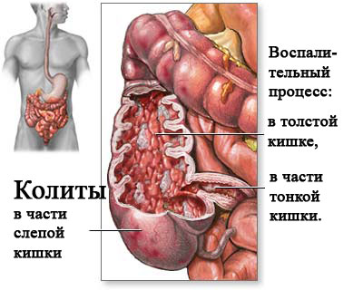 Хронічний спастичний коліт лікування - модна красива