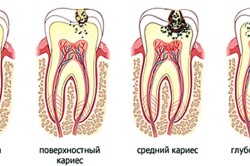 Чим небезпечний карієс зубів