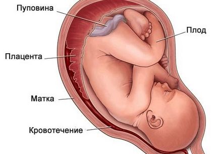 Гематома в матці при вагітності як розсмоктується на ранніх термінах, симптоми і лікування