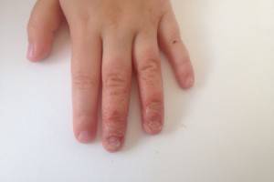 szegező gomba ujját kúra