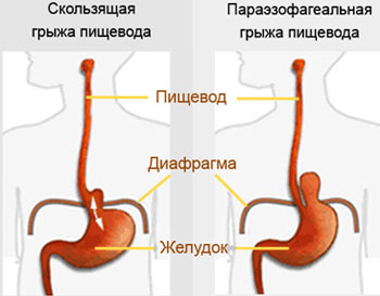 Грижа стравоходу лікування, симптоми, дієта, рекомендації