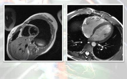 Мрт серця і коронарних судин що показує