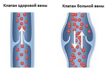 Причини варикозу від чого з'являється і психосоматика варикозного розширення вен