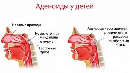 Дитина сопе носом, але соплів немає що робити у новонародженого