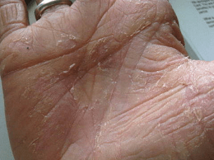 Descuamarea pielii de pe palme de ce să facă, primul-03 Boli director al  bolilor umane