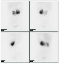 Сцинтиграфія нирок (нефросцінтіграфія), мій уролог