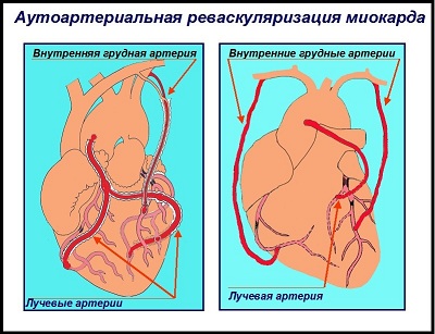 Бімаммарное коронарне шунтування