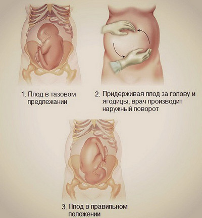 Що означає тазове передлежання плода, і як проходять пологи (тазове) Що означає тазове передлежання плода, і як проходять пологи