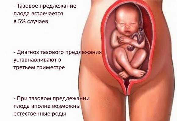 Що означає тазове передлежання плода, і як проходять пологи (тазове) Що означає тазове передлежання плода, і як проходять пологи