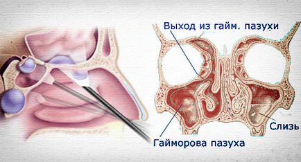 Кіста гайморової (носовий) пазусі симптоми і лікування