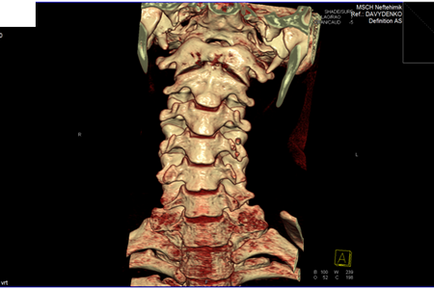 Комп'ютерна томографія хребта шийного, грудного, попереково-крижового відділу