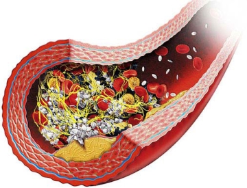 Bél mesenterialis thrombosis és módja, hogy megőrizze az élet