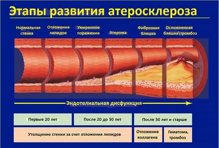 Нестенозірующій атеросклероз внечерепних брахіоцефальних артерій - лікування БЦА