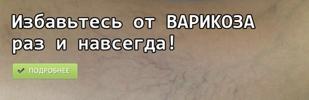 Оклюзійний тромбоз медіальної суральних вен нижніх кінцівок глибоких вен гомілки, лікування