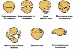 Перелом надколінка симптоми, лікування і наслідки