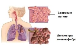 Пневмофіброз легких що це, симптоми і лікування