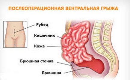 Післяопераційна грижа (вентральна) - черевної порожнини, лікування, після операції на животі,