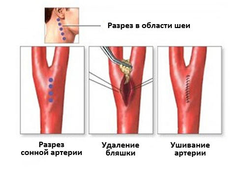 Стенози сонних артерій і сучасні методи їх лікування, ооо «медсервис» - лідер медицини