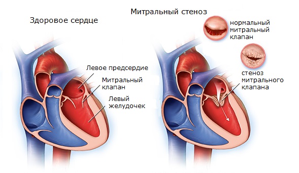 A mitrális billentyű stenosis tünetek, kezelés, hemodinamika, típusok, diagnózis