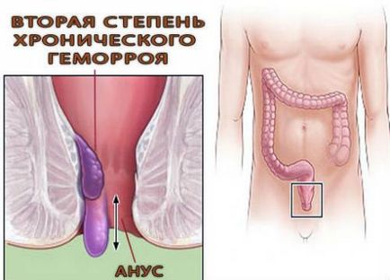 Види геморою класифікація, які бувають різновиди, способи лікування